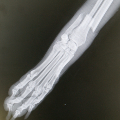 Röntgenbild eines Bruches